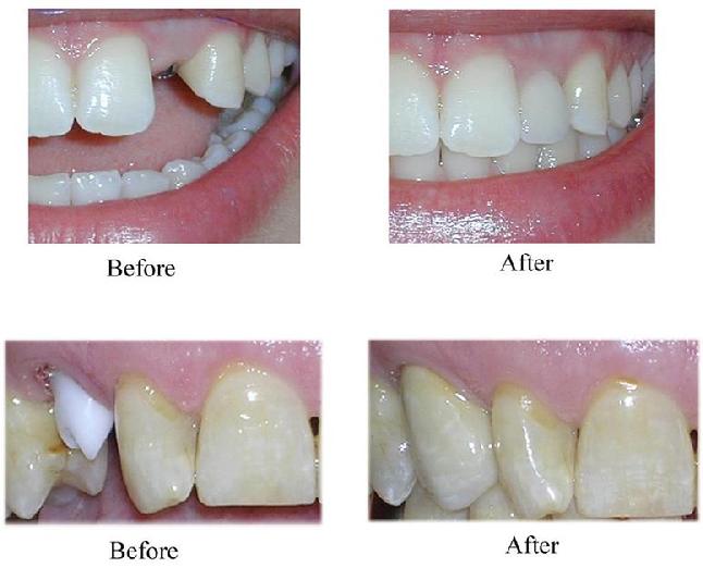 Dental Bonding - Before and After at Preventive Dentistry Braddon